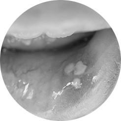 mouth ulcers mouth ulcers